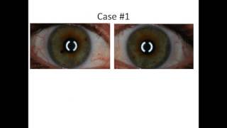 Mixed Iris Assessment Case 1 [upl. by Solita]