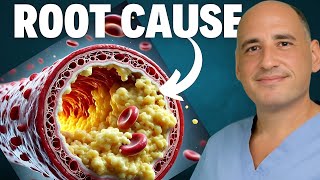 Heart Surgeon’s TRUTH about Carnivore Diet amp Cholesterol [upl. by Matthias]