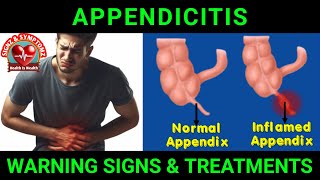 Appendicitis Symptoms and Treatment Options appendicitis [upl. by Janetta925]