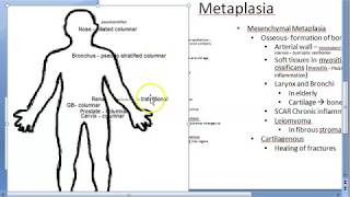 Pathology 038 a Metaplasia types Cell adaptation atrophy hypertrophy hyperplasia squamous columnar [upl. by Loresz]