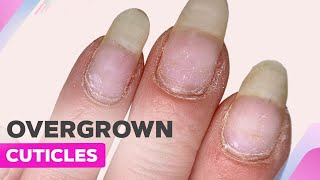 Overcome Dry Cuticle with EFile Tips  Glitter Ombre Nail Art [upl. by Nivalc]