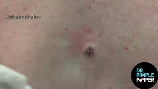 8 MINUTES OF SATISFYING POPS with Dr Sandra Lee  Dr Pimple Popper [upl. by Adeline387]