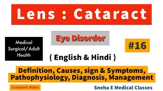 Lens Cataract in Hindi [upl. by Jojo]