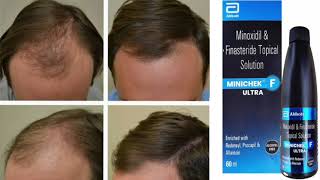 MINICHEK F ULTRA Topical Solution Minoxidil amp Finasteride Topical Solution [upl. by Manouch]