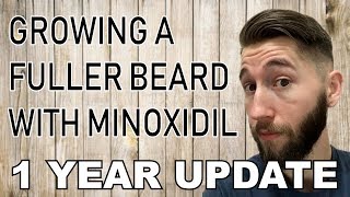 Minoxidil Beard  1 Year  Before and After Pic [upl. by Enella976]