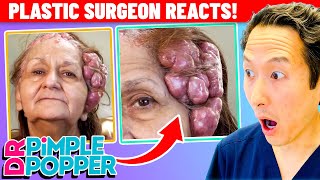 Plastic Surgeon Reacts to DR PIMPLE POPPER 100 Masses On Her Head [upl. by Eladal]