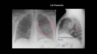 Chest Xray Cases 1 [upl. by Gala]