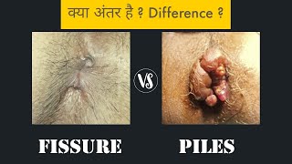 Piles vs Fissure  Difference [upl. by Stier]