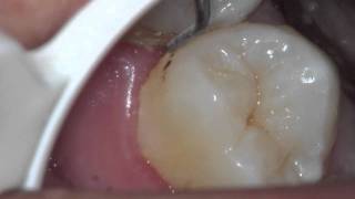 Severe Gingivitis [upl. by Abramson]