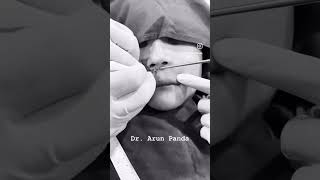 Subnasal Lip Lift Surgery Enhance Your Lips with Dr Arun Panda [upl. by Iveel49]