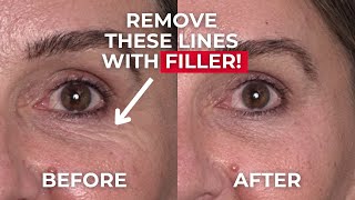 Safe Tear Trough Injection Tutorial with Dermal Filler [upl. by Lesslie411]