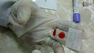 Blood smear preparation2 methods to learnThick amp Thin smear preparation [upl. by Enilatan92]