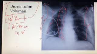 Lección 26 Hiperinflación y Disminución Volumen Pulmonar Campos Pulmonares Radiografía Torax [upl. by Mcquade52]