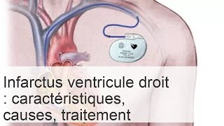 Infarctus du ventricule droit  symptômes traitement et prévention [upl. by Starlene]