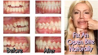 How To Fix An Open Bite Naturally No Braces No Surgery [upl. by Burlie]