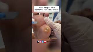 Ultimate Callus Removal Full Treatment For Smooth Feet  FootClinicLondoncouk [upl. by Redep]