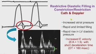 Constrictive Pericarditis [upl. by Kurman]