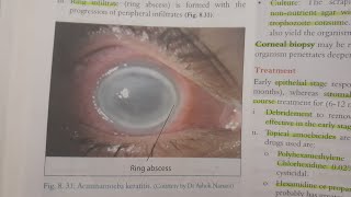 Acanthamoeba Keratitis  EYE [upl. by Ignacius]