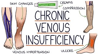 Understanding Chronic Venous Insufficiency [upl. by Eliason391]