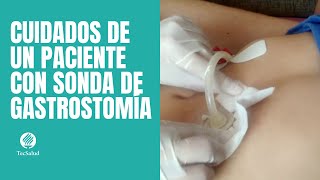 Cuidados de paciente con sonda de gastrostomía [upl. by Ilene]