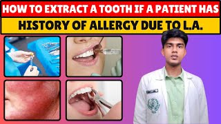 How to Extract a Tooth if Patient has known history of Allergic Reactions due to Local Anesthesia [upl. by Auric]