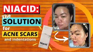 Niacid by Slurp Review Part I  Serum for Acne Scars and Indentations  Niacinamide [upl. by Tiphanie662]