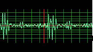 Infective Endocarditis Mitral Regurgitation normal speed [upl. by Peadar]