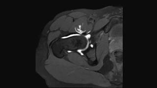 Labral tear and CAM impingement of the hip  complete MRI examination [upl. by Eisteb]