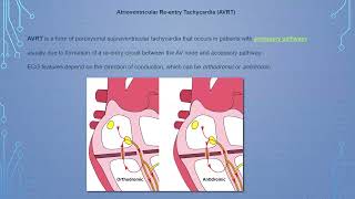 3 tachyarrhythmia Dr hesham [upl. by Gabie]