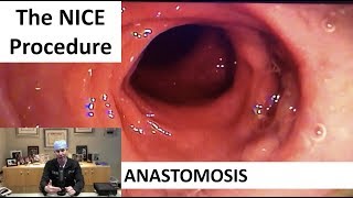 The NICE Procedure PostOP Anastomosis [upl. by Eldwen727]