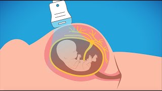 Advanced prenatal genetic testing [upl. by Emanuel949]