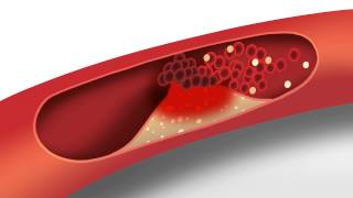 Cholesterol animation  Heart disease risk factors [upl. by Aekahs]