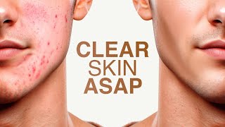 how to get clear skin for guys asap full guide [upl. by Nitsuj]