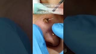 Procedure of Mole removal by Radiofrequency mole removal on face by Laser Dermatologist [upl. by Elockin]