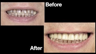 Case of the Week Restoring Severely Stained Preparations with BruxZir® Solid Zirconia [upl. by Tan895]