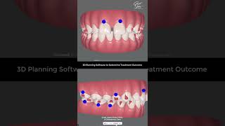 Correction of Gaps in Teeth with Invisalign Braces  Invisalign Kolkata invisalign clearaligner [upl. by Ibbob]