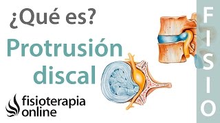 Protrusión discal subligamentosa  ¿Qué es [upl. by Yddet596]