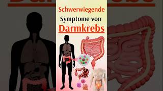 Schwerwiegende Symptome von Darmkrebs [upl. by Ellata]