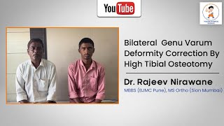 Bilateral Genu Varum Deformity Correction By High Tibial Osteotomy [upl. by Bradford]