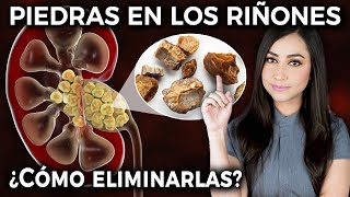 PIEDRAS EN LOS RIÑONES ¿Qué SÍNTOMAS causan y cómo ELIMINARLAS Cálculos renales👩🏻‍⚕️ drapauzuniga [upl. by Pears]