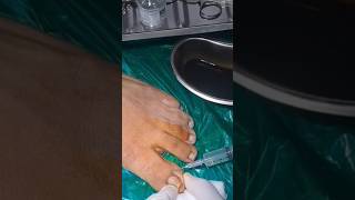 Nail Ingrowth removal Under Local Anaesthesia doctortips healthadvice ytshort drashwinraturi [upl. by Hopper]