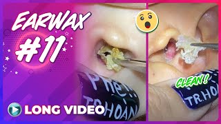 EP 11 Earwax ASMR  Series remove earwax after not cleaning for a long time [upl. by Ydrah105]