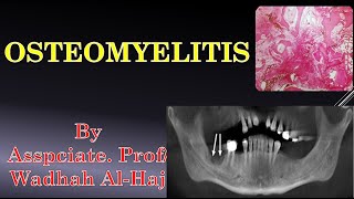 5 Osteomyelitis Dr Wadhah Oral Pathology lectures د وضاح الحاج [upl. by Albemarle]