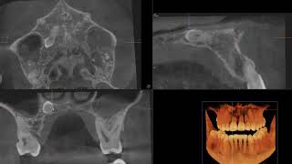 Supernumerary tooth in hard palate [upl. by Jeannie237]