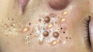 Extreme Blackhead Removal at LNG Skin Care 7214 [upl. by Wernda]