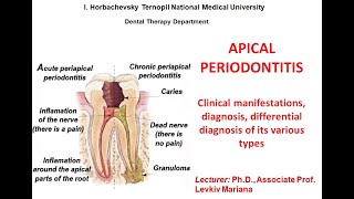 lecture Apical periodontitis [upl. by Shana480]