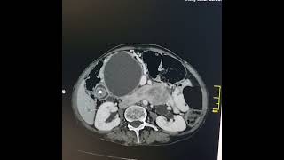 Intraductal calculi surrounding retained bile duct stentsmasses and a cystic lesion in pancreas [upl. by Ancier]