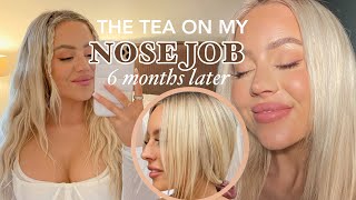 6 month nose job update regrets advice  kasey rayton [upl. by Balliett252]