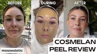 COSMELAN DEPIGMENTATION PEEL  chemical peel for pigmentation  dark spots [upl. by Lauryn558]