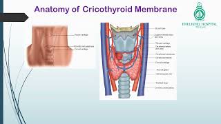 Cricothyroidotomy [upl. by Adnohsek]